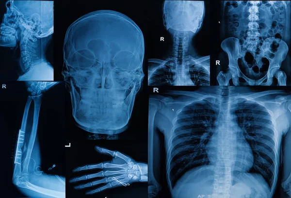 Kolekce X-ray, více část dospělých Ukázat zlomenina bon — Stock fotografie