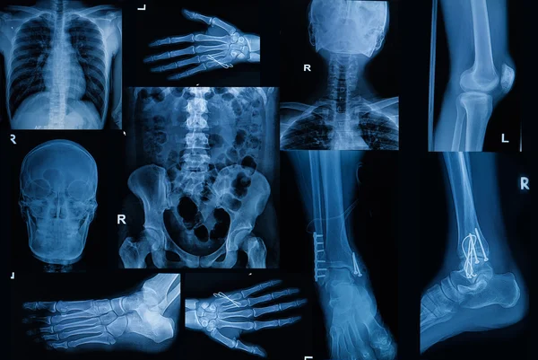 Kolekce X-ray, více část dospělých Ukázat zlomenina bon — Stock fotografie