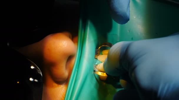 Concetto di cura dentale e dei denti. processo di installazione di impiallacciature. Impiallacciature impostazione in odontoiatria moderna. Primo piano di paziente donna in sedia con procedura di installazione di faccette di porcellana, 4 k — Video Stock