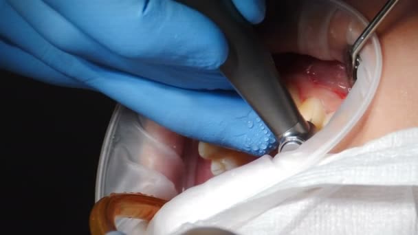 Concetto di cura dentale e dei denti. processo di installazione di impiallacciature. Impiallacciature impostazione in odontoiatria moderna. Primo piano di paziente donna in sedia con procedura di installazione di faccette di porcellana, 4 k — Video Stock