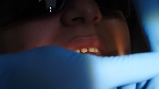 Zahn- und Zahnpflege-Konzept. Prozess der Installation von Furnieren. Veneers Einstellung in der modernen Zahnmedizin. Nahaufnahme einer Patientin im Stuhl mit Verlegung von Porzellanfurnieren, 4 k — Stockvideo