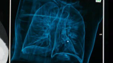 Coronavirus Covid-19 solunum hastalığına sahip akciğerlerin tomografisi. X-ray Manyetik Rezonans görüntüleme. Tomografi sonuçların animasyonu. Göğüs tomografisi. 4k video