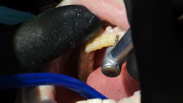 Διαδικασία εγκατάστασης καπλαμά. Το περιβάλλον των Βενετών στη σύγχρονη οδοντιατρική. Κοντινό πλάνο του γυναικείου ασθενή σε καρέκλα που έχει πορσελάνη veneers διαδικασία εγκατάστασης, δόντια ετοιμάζεται για καλλυντικά veneers — Αρχείο Βίντεο