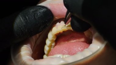 Kaplama işlemi başlatılıyor. Delmek için aletleri olan dişçi izleri. Sandalyedeki kadın hasta porselen kaplama taktırıyor, dişleri kozmetik kaplamaya hazırlanıyor. 4 k video