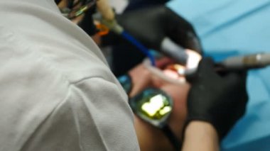 Veneers modern dişçiliğe yükleniyor. Sandalyedeki kadın hastayı porselen kaplama taktırırken, dişleri kozmetik kaplamaya hazırlanırken yakın plan çekimde çek. Üst Manzara. 4 k video