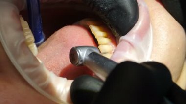 Veneers modern dişçiliğe yükleniyor. Sandalyedeki kadın hastayı porselen kaplama taktırırken, dişleri kozmetik kaplamaya hazırlanırken yakın plan çekimde çek. Sondaj. 4 k video