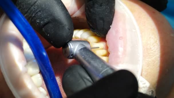 Veneers Installation in der modernen Zahnmedizin. Nahaufnahme einer Patientin im Stuhl, die Porzellanfurniere installiert, Zähne, die sich für kosmetische Furniere vorbereiten. Bohren. 4 k video — Stockvideo