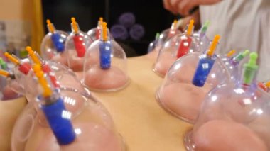 Kaplama işlemi. Akupunktur terapisindeki kadın hastaların sırtına Hijamah fincanları. Geleneksel Çin tedavisi. Tıbbi destek terapi ekipmanları. Sağlık uzmanı kupa çekme tekniğini uyguluyor. 4 bin.