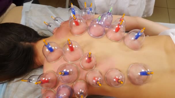 Vakuumkupomassage. Tibetansk medicin. Akupunktur kupering behandling. Anti-celluliter massage förfarande med vakuumburkar eller burkar, banker. 4 k video — Stockvideo