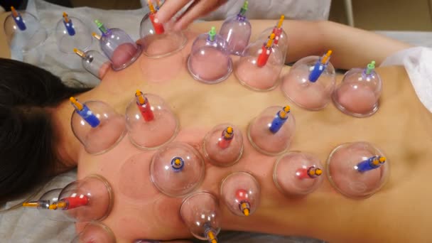 Cosmetic body massage with cupping glass. Massage Spa Therapy Treatment using glass cupping jars, Acupuncture technique . Chinese Traditional treatment. Medical cupping equipment. 4 k video — Stock Video