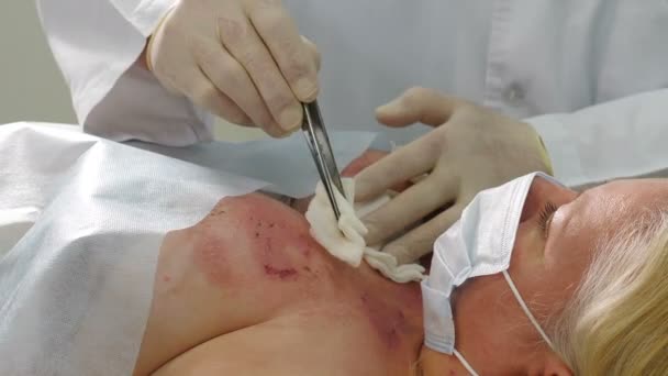 Il medico disinfetta e cura la ferita cutanea bruciata sulla zona toracica in caso di emergenza. Squadra di chirurghi che lavora con pelle bruciata sul seno. Medico ferita da debriding con batuffoli di cotone bagnati con soluzione. 4 k — Video Stock