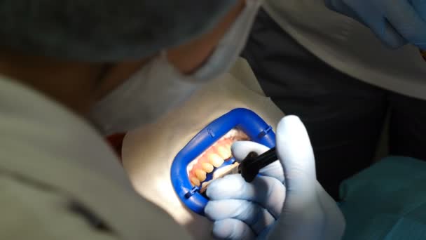 一队医生让女病人准备好拔牙的隔离牙龈。完美的笑与白牙齿。牙齿美白程序。4k视频 — 图库视频影像