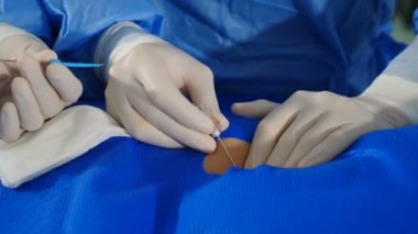 Damar ameliyatı. Radyolog anjiyografi makinesiyle endovasküler ameliyat yapıyor. Doktor rahim fibroid embolizasyonu için kontrast sıvısı kullanıyor. Kardiyo-vasküler muayene. 4k video