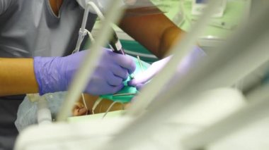 Modern diş kliniği. Tıbbi ekip stomatoloji kliniğinde tedavi sırasında eldiven takan sterilize aletlerle çalışıyor. Dişçi çocukların dişlerini tedavi ediyor. Cerrahi dişçilik. 4 k video