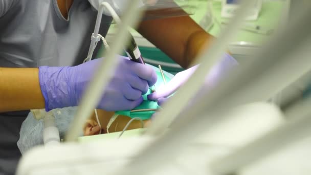 현대 치과 병원. 구균 클리닉에서 치료중에 장갑을 끼고 살균 된 도구를 가지고 일하는 의료 팀. 치과 의사들은 아이들의 치아를 치료 합니다. 외과의 치 과학. 4k 비디오 — 비디오