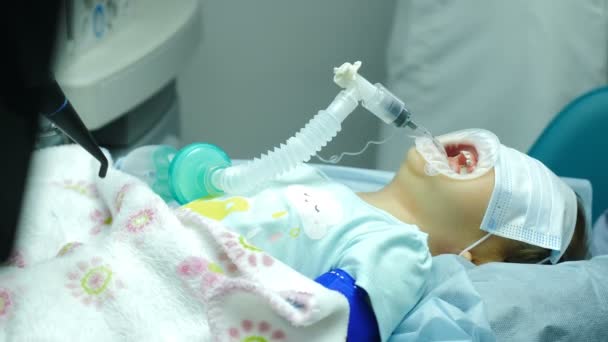 Zahnbehandlung bei Kindern unter Vollnarkose. Zahnarzt behandelt Zähne von Mädchen. Team professioneller Zahnchirurgen, die invasive Operationen an Patienten mit Vollnarkose durchführen. 4 k — Stockvideo