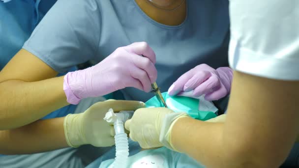 Zahnbehandlung bei Kindern unter Vollnarkose. Zahnarzt behandelt Zähne von Mädchen. Team professioneller Zahnchirurgen, die invasive Operationen an Patienten mit Vollnarkose durchführen. 4 k — Stockvideo
