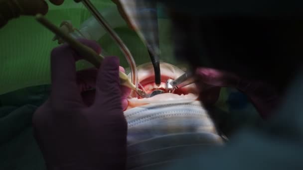 Female child patient having teeth treated by dentist. Dental surgery. operating room in modern dental clinic. Close-up shot. modern orthodontic cases. 4 k video — Stock Video