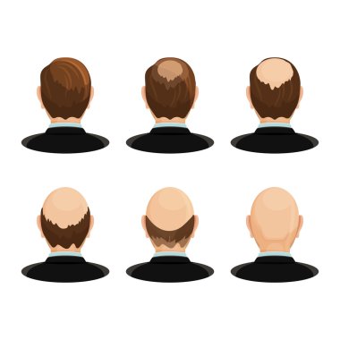 Alopesi kavramı. Saç dökülmesinin ilerlemesini gösteren kafalar seti.