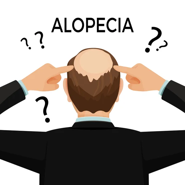 Alopecia concept. Man is showing his hairloss nape. — Stock Vector