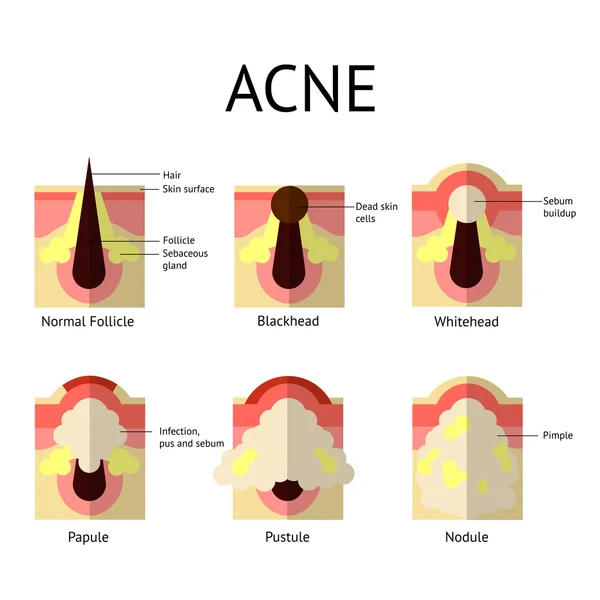 Tipos de espinhas de acne. Pele saudável, Whiteheads e Blackheads, Pápulas e pústulas em estilo plano . —  Vetores de Stock