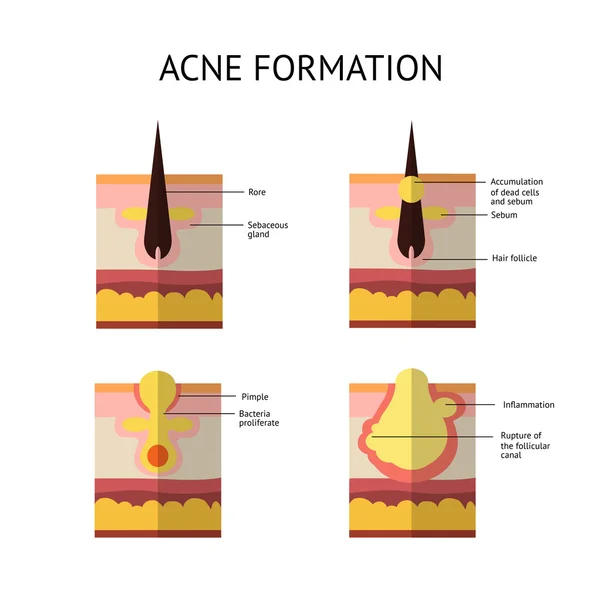 Bildandet av hud acne eller finne. Talg i tilltäppta porerna främjar tillväxten av vissa bakterier. Propionibacterium Acnes. Detta leder till rodnad och inflammation i samband med finnar. — Stock vektor