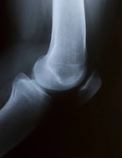 X-ray of a knee — Stock Photo, Image