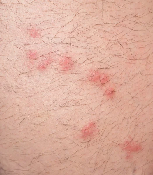 Flea bites over caucasian man hairy skin — Stock Photo, Image