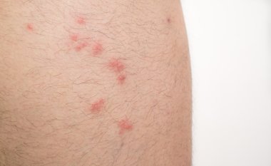 flea bites on caucasian man leg clipart