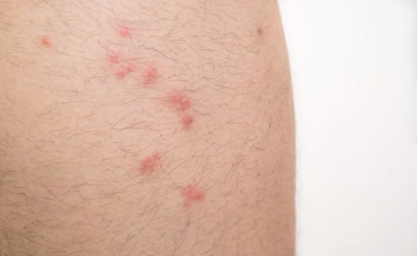 Picadas de pulgas na perna do homem caucasiano Fotografias De Stock Royalty-Free