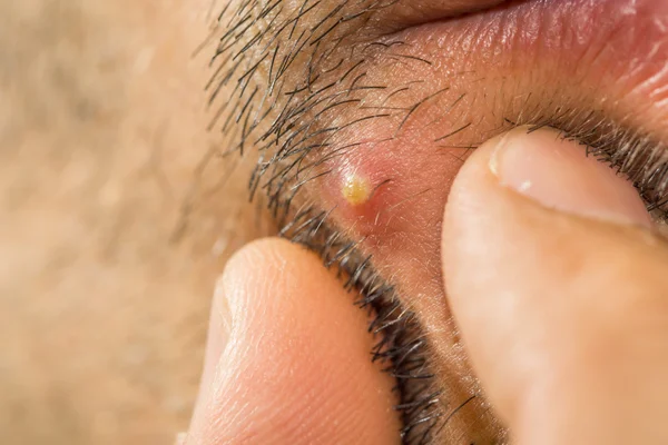 Extremo primer plano de caucásico hombre con stub apretando una espinilla — Foto de Stock