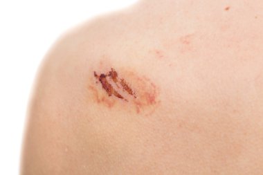 Sol omuz üzerinde çizik closeup görünümü