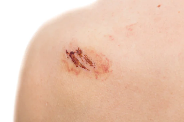 Closeup view of Scratch over left shoulder — Stock Photo, Image