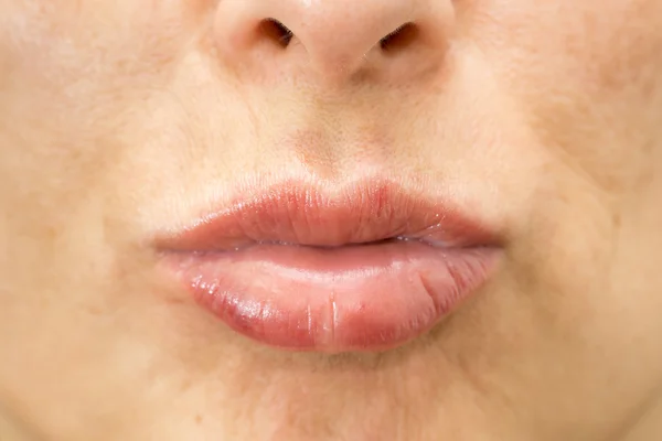 Primer plano de los labios hinchados de la mujer después del tratamiento de belleza —  Fotos de Stock