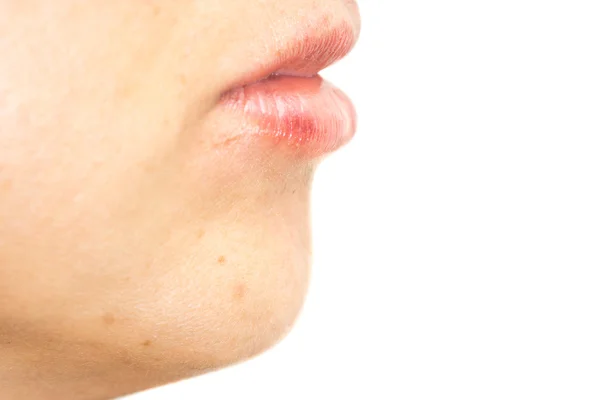 Крупный план женщины с опухшими губами после косметических процедур, вид сбоку — стоковое фото