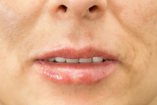 Primer plano de los labios hinchados de la mujer después del tratamiento — Foto de Stock