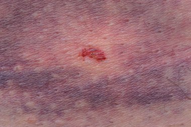 Beyaz Cilt üzerinde büyük çürük makro