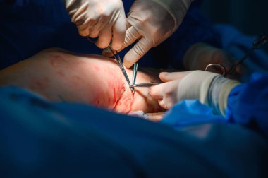 Phlebectomy operasyonu. Damarların cerrahi yolla alınması