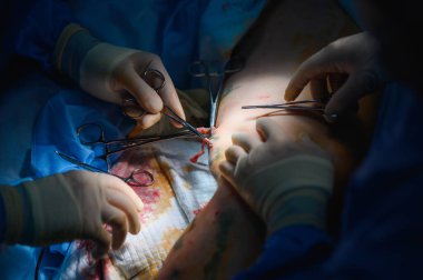 Phlebectomy operasyonu. Damarların cerrahi yolla alınması