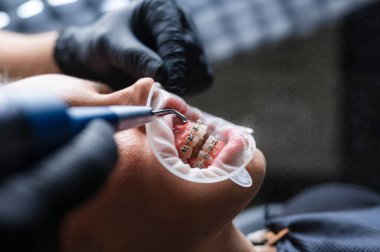 Döner Eldiven Eldiveni ile Yakın Çekim Diş Yenileme Üst Azıdişleri Matkabı Üzerinde Çalışan Eldiven Kliniği