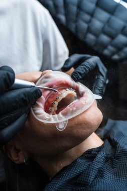 Kapatma Diş Prosedürü Açık Ağız, Siyah Eldiven Giyen Dişçi Ayarlamak için Döndürme Aracı Kullanıyor