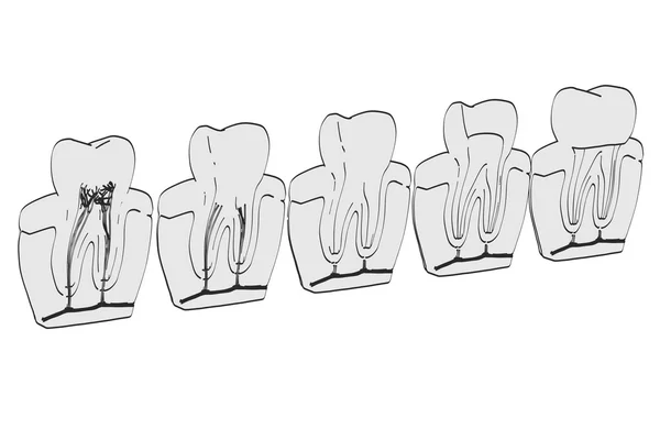 Endodontics 2D karikatür çizimi — Stok fotoğraf