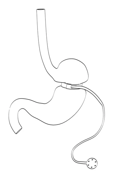 2D καρτούν εικονογράφηση του στομάχου με γαστρικό μπάντα — Φωτογραφία Αρχείου