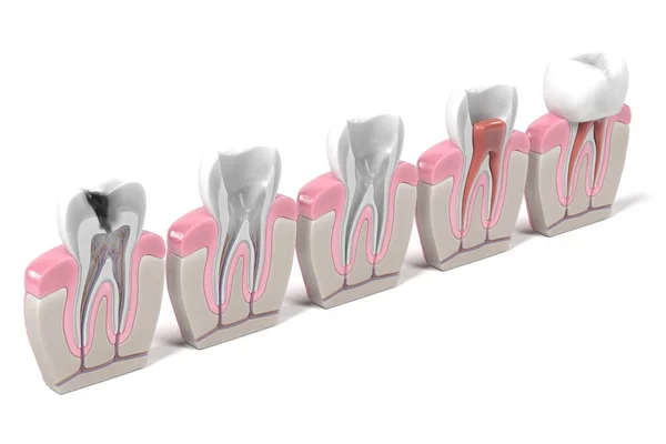 endodontics - kanal prosedürü 3D render