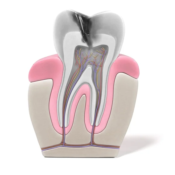Endodontics - kanal prosedürü 3D render — Stok fotoğraf