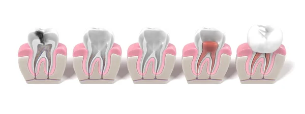 3D vizualizace endodoncie - kořenových kanálků Postup Stock Obrázky