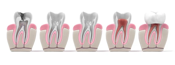 Endodontics - kanal prosedürü render — Stok fotoğraf