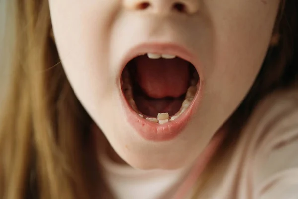 Dorosłe Zęby Stałe Wchodzące Przed Zęby Dziecka Zęby Rekina Mała — Zdjęcie stockowe