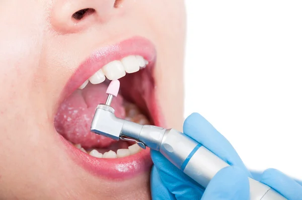 Dentista usando pedra de polimento rosa para remover a placa dos dentes — Fotografia de Stock