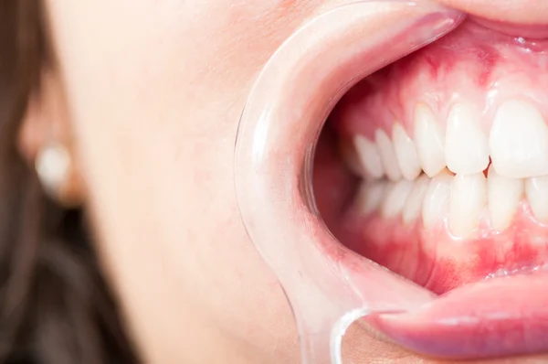 Close-up de meia boca com retrator de plástico e dentes — Fotografia de Stock